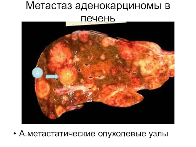 Метастаз аденокарциномы в печень А.метастатические опухолевые узлы А