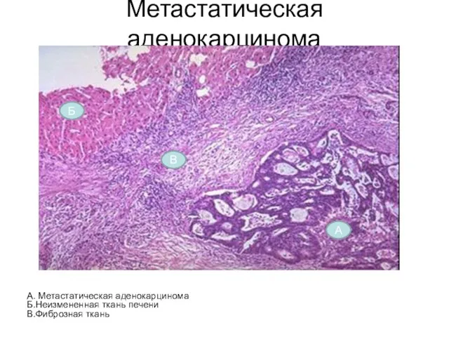 Метастатическая аденокарцинома А. Метастатическая аденокарцинома Б.Неизмененная ткань печени В.Фиброзная ткань Б А В