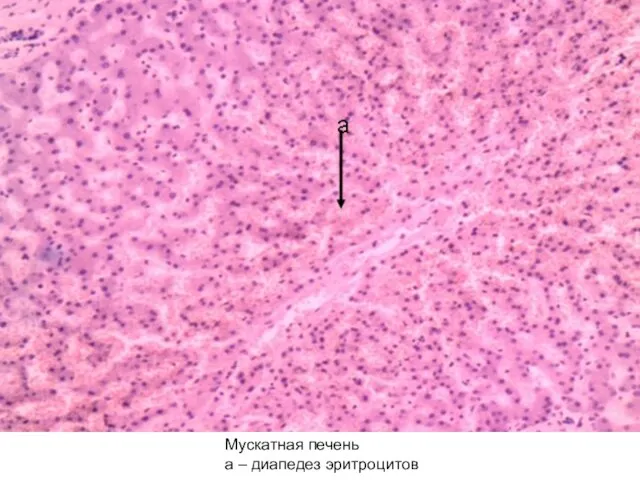 Мускатная печень а – диапедез эритроцитов