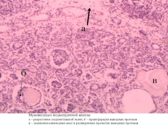 Муковисцидоз поджелудочной железы а – разрастания соединительной ткани; б –