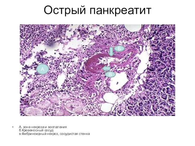 Острый панкреатит А. зона некроза и воспаления б.Кровеносный сосуд в.Фибриноидный некроз, сосудистая стенка А Б В