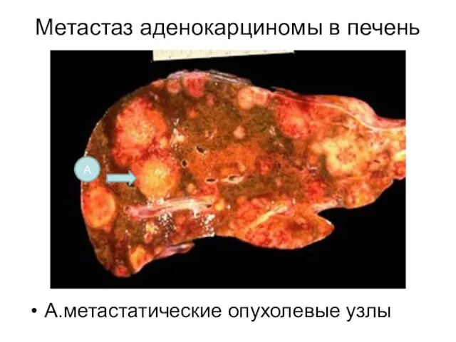 Метастаз аденокарциномы в печень А.метастатические опухолевые узлы А