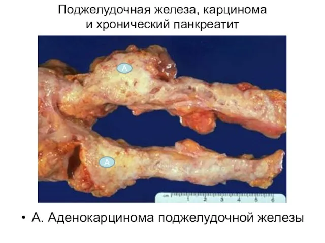 Поджелудочная железа, карцинома и хронический панкреатит А. Аденокарцинома поджелудочной железы А А