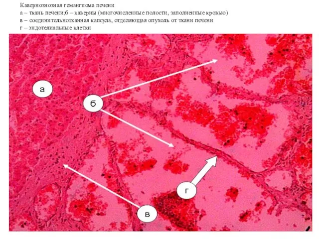 Кавернознозная гемангиома печени а – ткань печени;б – каверны (многочисленные