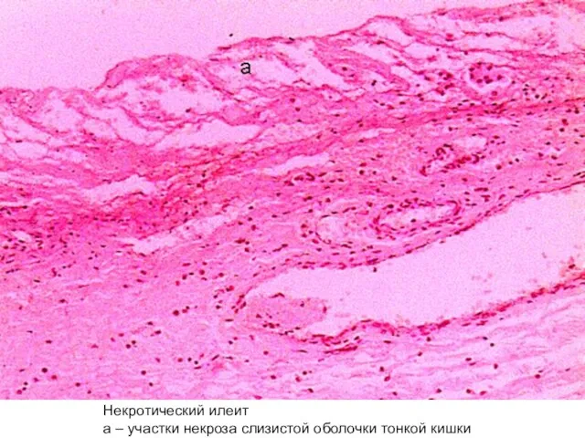 Некротический илеит а – участки некроза слизистой оболочки тонкой кишки