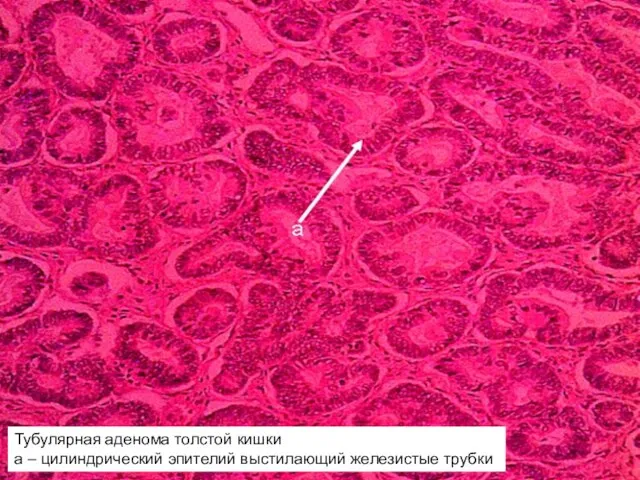 Тубулярная аденома толстой кишки а – цилиндрический эпителий выстилающий железистые трубки