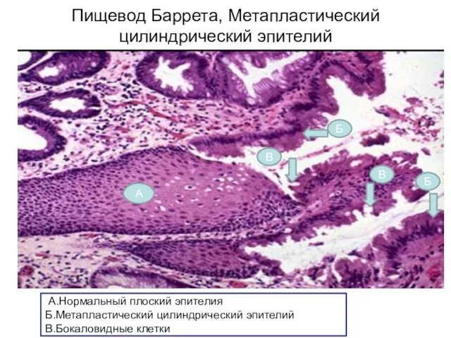 Пищевод Баррета, Метапластический цилиндрический эпителий А Б Б В В