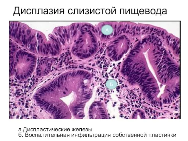 Дисплазия слизистой пищевода а.Диспластические железы б. Воспалительная инфильтрация собственной пластинки А Б