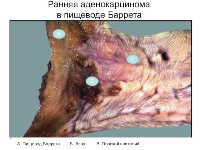 Ранняя аденокарцинома в пищеводе Баррета А. Пищевод Баррета Б. Язва В. Плоский эпителий А Б В