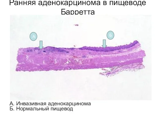 Ранняя аденокарцинома в пищеводе Барретта А. Инвазивная аденокарцинома Б. Нормальный пищевод Б А