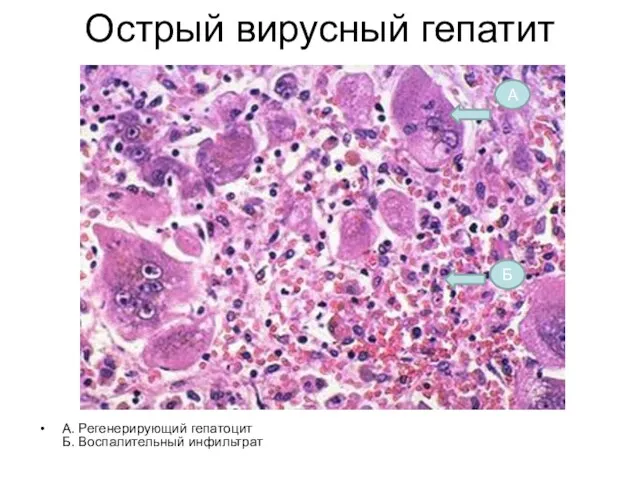 Острый вирусный гепатит А. Регенерирующий гепатоцит Б. Воспалительный инфильтрат А Б