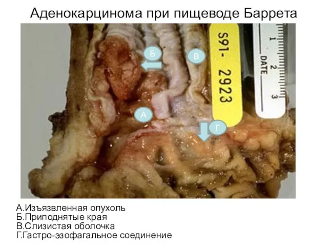 Аденокарцинома при пищеводе Баррета А.Изъязвленная опухоль Б.Приподнятые края В.Слизистая оболочка Г.Гастро-эзофагальное соединение А Б В Г