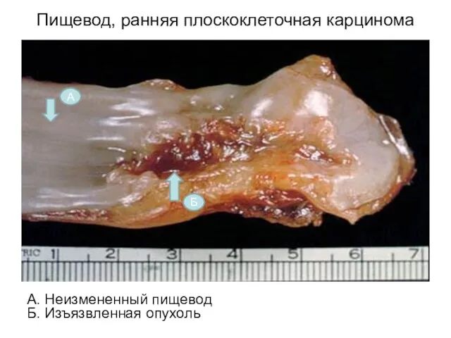 Пищевод, ранняя плоскоклеточная карцинома А. Неизмененный пищевод Б. Изъязвленная опухоль А Б