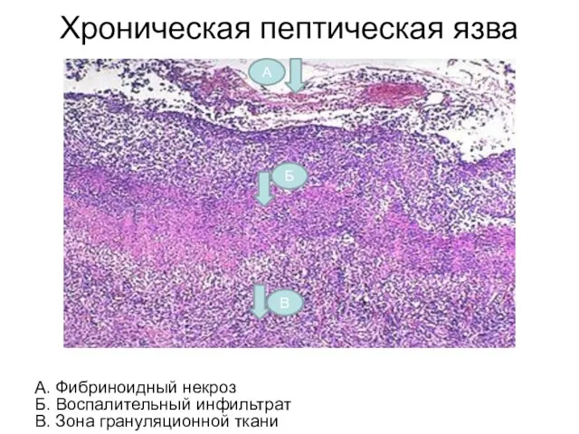 Хроническая пептическая язва А. Фибриноидный некроз Б. Воспалительный инфильтрат В. Зона грануляционной ткани А В Б