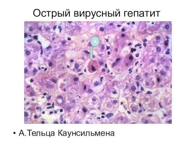 Острый вирусный гепатит А.Тельца Каунсильмена А