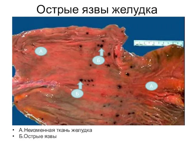 Острые язвы желудка А.Неизменная ткань желудка Б.Острые язвы А А Б Б