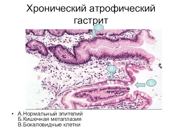 Хронический атрофический гастрит А.Нормальный эпителий Б.Кишечная метаплазия В.Бокаловидные клетки А В Б
