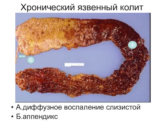 Хронический язвенный колит А.диффузное воспаление слизистой Б.аппендикс А Б