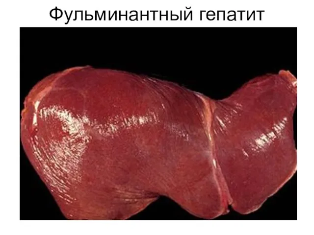 Фульминантный гепатит