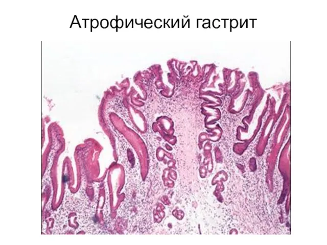 Атрофический гастрит