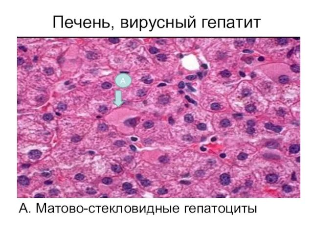 Печень, вирусный гепатит А. Матово-стекловидные гепатоциты А