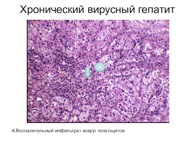 Хронический вирусный гепатит А.Воспалительный инфильтрат вокруг гепатоцитов А