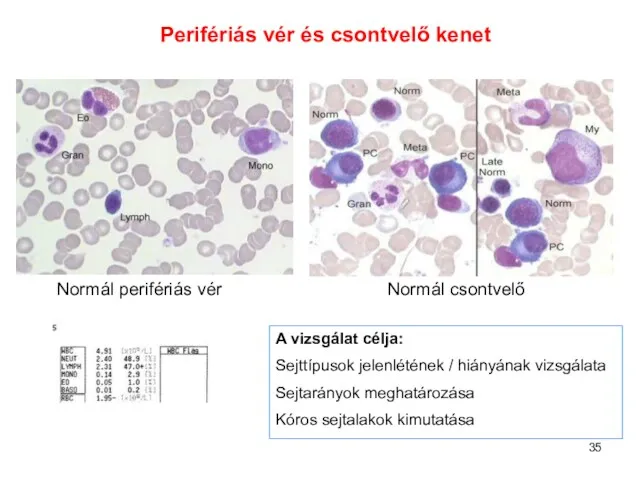 Normál perifériás vér Normál csontvelő Perifériás vér és csontvelő kenet A vizsgálat célja: