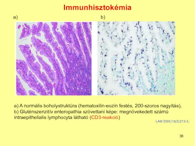 Immunhisztokémia a) A normális boholystruktúra (hematoxilin-eozin festés, 200-szoros nagyítás), b) Gluténszenzitív enteropathia szövettani