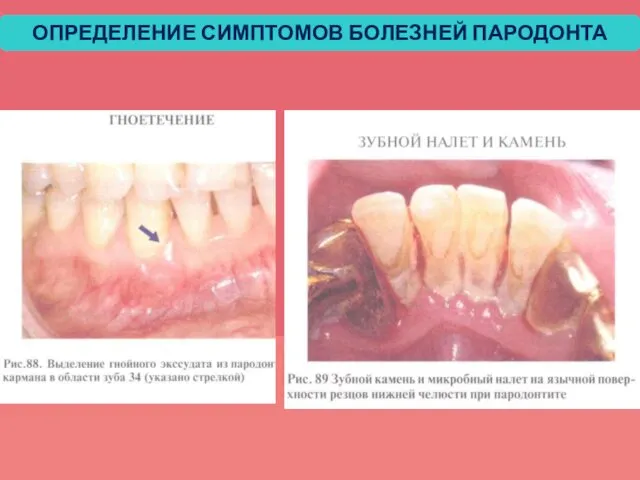 ОПРЕДЕЛЕНИЕ СИМПТОМОВ БОЛЕЗНЕЙ ПАРОДОНТА