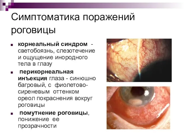 Симптоматика поражений роговицы корнеальный синдром - светобоязнь, слезотечение и ощущение