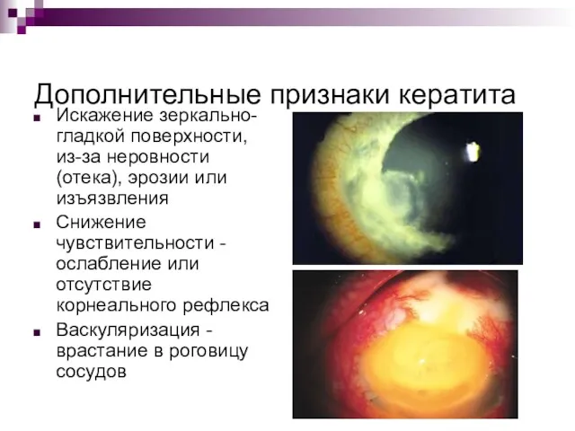 Дополнительные признаки кератита Искажение зеркально-гладкой поверхности, из-за неровности (отека), эрозии