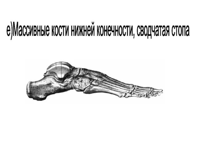 е)Массивные кости нижней конечности, сводчатая стопа