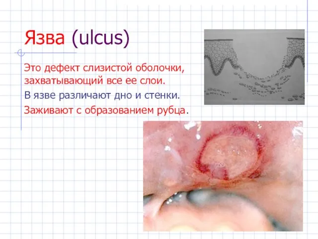 Язва (ulcus) Это дефект слизистой оболочки, захватывающий все ее слои. В язве различают