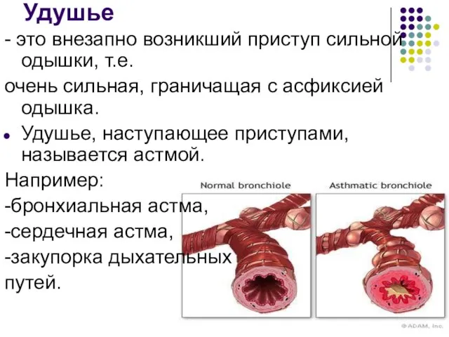 Удушье - это внезапно возникший приступ сильной одышки, т.е. очень