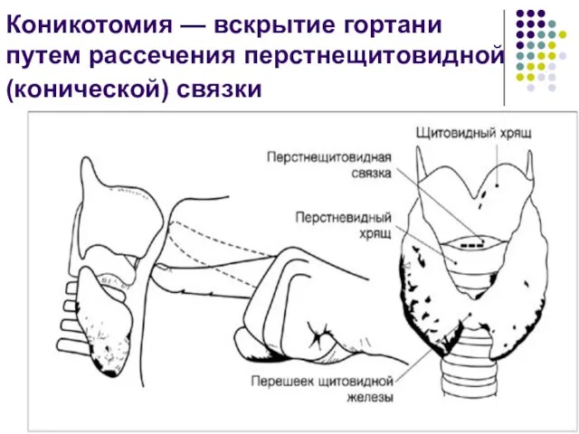 Коникотомия — вскрытие гортани путем рассечения перстнещитовидной(конической) связки