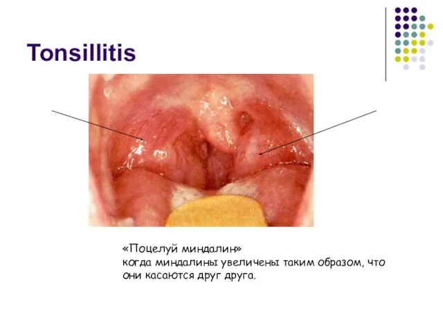 Tonsillitis «Поцелуй миндалин» когда миндалины увеличены таким образом, что они касаются друг друга.