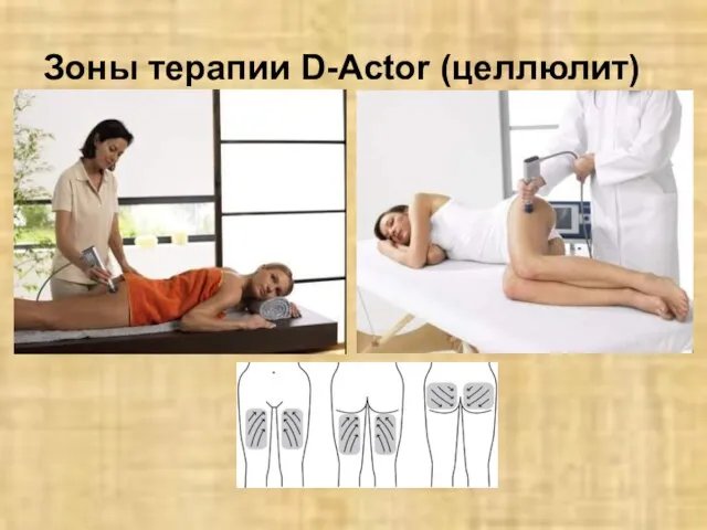 Зоны терапии D-Actor (целлюлит)