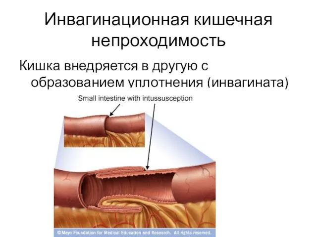 Инвагинационная кишечная непроходимость Кишка внедряется в другую с образованием уплотнения (инвагината)