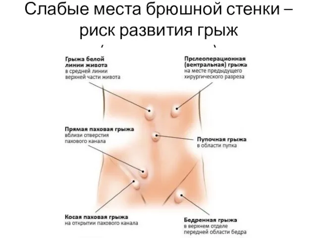 Слабые места брюшной стенки – риск развития грыж (выпячивание)