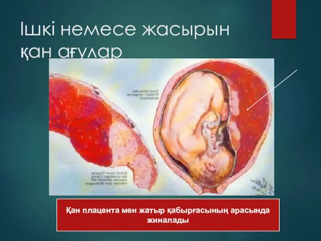 Ішкі немесе жасырын қан ағулар Қан плацента мен жатыр қабырғасының арасында жиналады