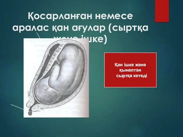 Қосарланған немесе аралас қан ағулар (сыртқа және ішке) Қан ішке және қынаптан сыртқа кетеді