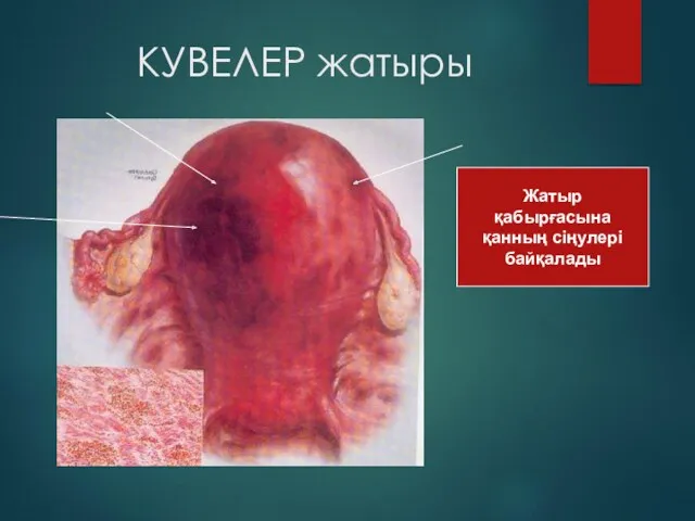 КУВЕЛЕР жатыры Жатыр қабырғасына қанның сіңулері байқалады