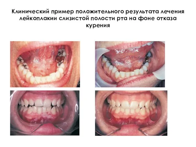 Клинический пример положительного результата лечения лейкоплакии слизистой полости рта на фоне отказа курения