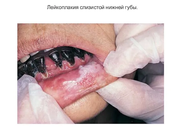 Лейкоплакия слизистой нижней губы.