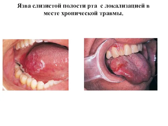 Язва слизистой полости рта с локализацией в месте хронической травмы.