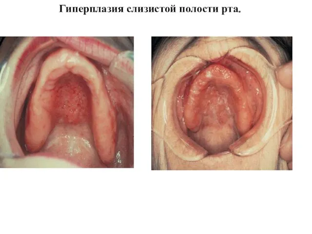 Гиперплазия слизистой полости рта.