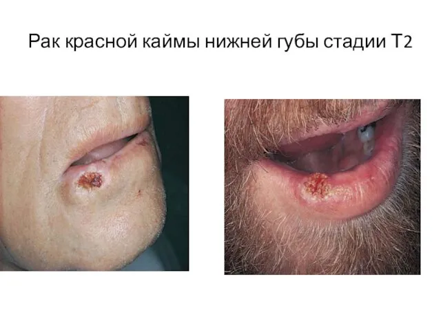 Рак красной каймы нижней губы стадии Т2