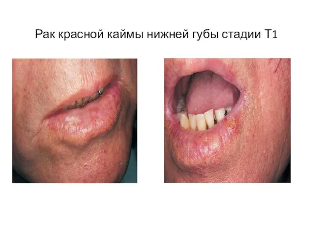 Рак красной каймы нижней губы стадии Т1
