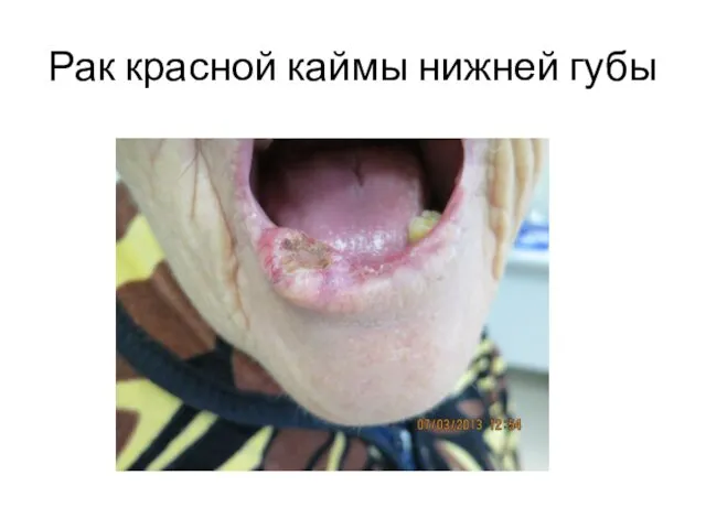 Рак красной каймы нижней губы