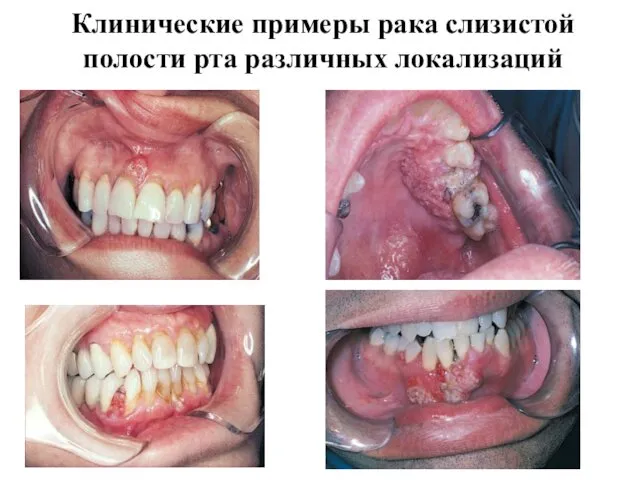 Клинические примеры рака слизистой полости рта различных локализаций